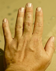 Indian researchers say the creases between fingers on the back of the hand can indicate a person's cholesterol levels. (Photo: David DeHetre via Flickr/Creative Commons)