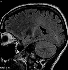 An MRI image of an ALS patient shows increased activity, and not of a good kind, in the motor cortex.  (Wikipedia Commons)