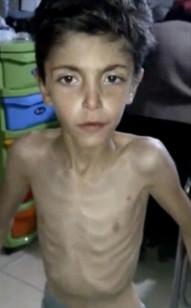 An emaciated Syrian boy receives treatment at a local field clinic in Madaya, Syria, in an image taken from video posted by Madaya Medical Corps on Jan. 8, 2016. (AP)