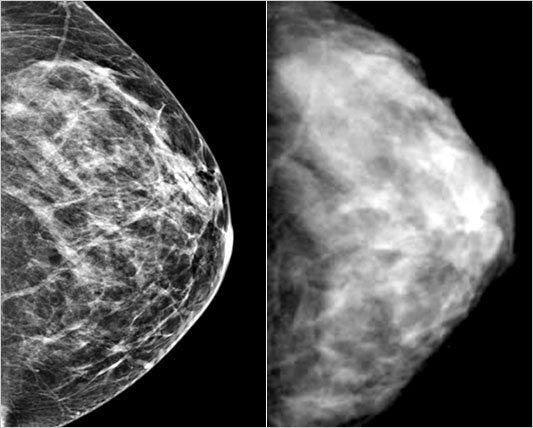 mammography