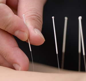 acupuncture