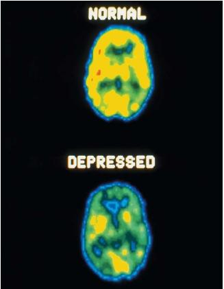 Crregullimi bipolar