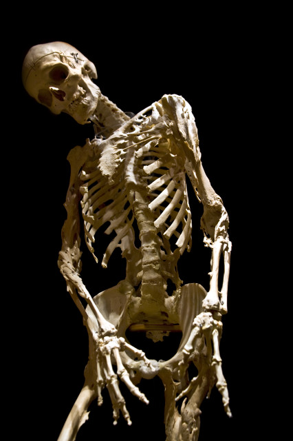 The skeleton of Harry Eastlack, a sufferer of Fibrodysplasia Ossificans Progressiva (FOP) (Evi Numen/Mütter Museum)