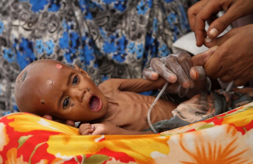 "Somalia Malnourished Child"