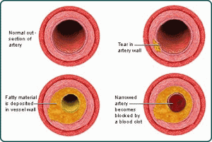 High LDL cholesterol levels lead to plaque build up on artery walls (Image: CDC)