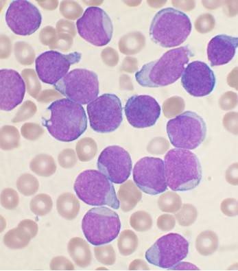 A microscopic view (purple)of precursor B-cell acute lymphoblastic leukemia - B-ALL. (VashiDonsk/Wikimedia Commons)
