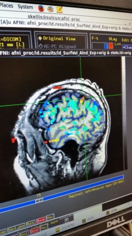 Example of an fMRI scan used for targeting the device implantation location. (Caltech)