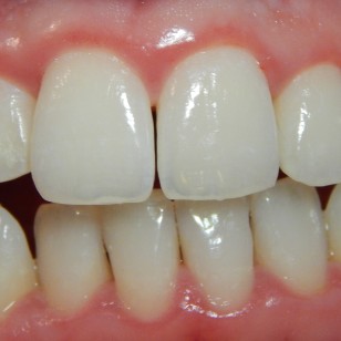 Gingivitis after treatment (Wikimedia Commons)