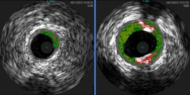 Cross-sectional ultrasound images of coronary arteries from patients enrolled in the study. Plaque buildup (colored areas) in an artery from a patient that lacks sensitivity to red meat allergen (left) is much lower than plaque levels in an artery from a patient with sensitivity to red meat allergen (right). (Angela Taylor, M.D., University of Virginia Health System)