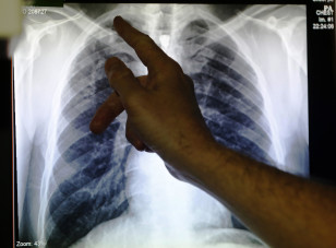 A doctor points to an x-ray showing a pair of lungs infected with TB (tuberculosis) in Ladbroke Grove in London, England, Jan. 27, 2014.