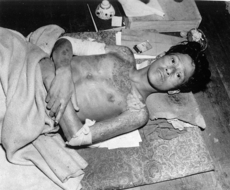 A young and ill man, a victim of the second atomic bomb ever used in warfare, is shown in Nagasaki, in late 1945. The bombing killed more than 70,000 people instantly, with ten thousands dying later from effects of the radioactive fallout.  (AP)